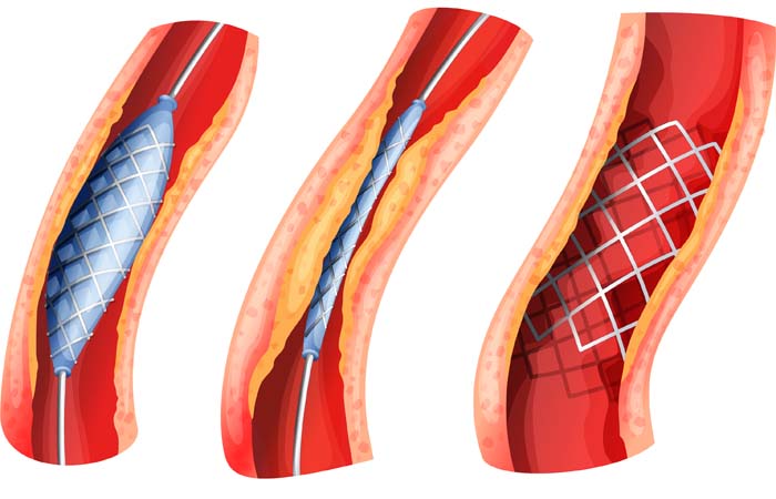 illustration die beschreibt wie ein stent funktioniert